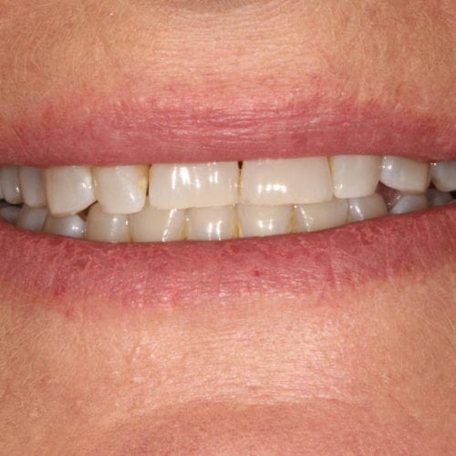 Before cosmetic dentistry at Columbia Family Dental Care