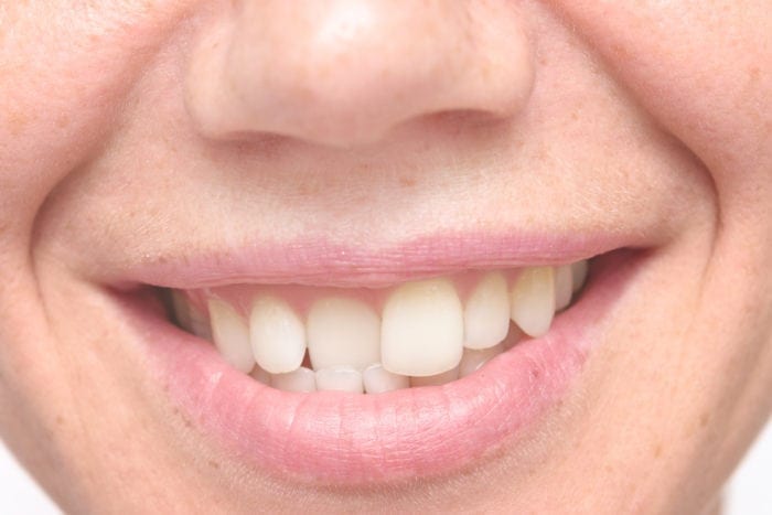 Straighten Crooked Teeth in Columbia, Maryland