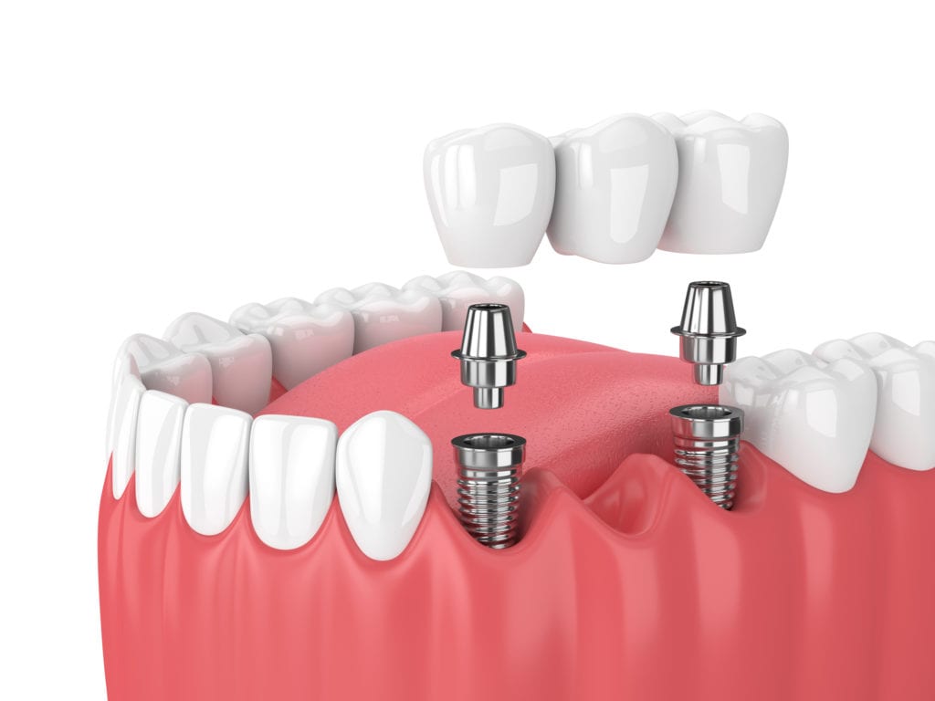 Dental Bridges in Columbia, Maryland