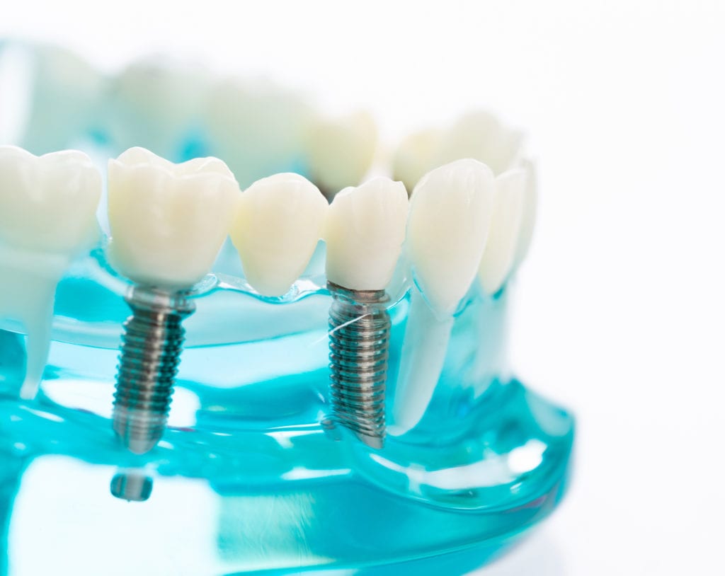 Dental Implant Treatment in Columbia, Maryland