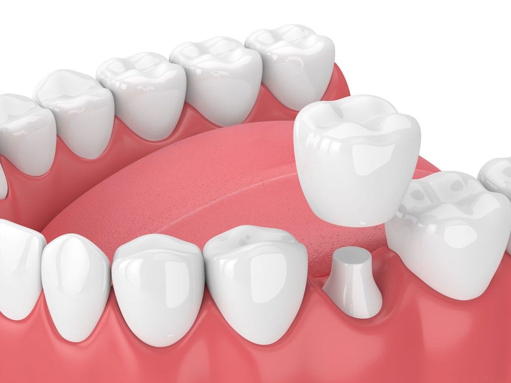 dental crown treatment in Columbia Maryland