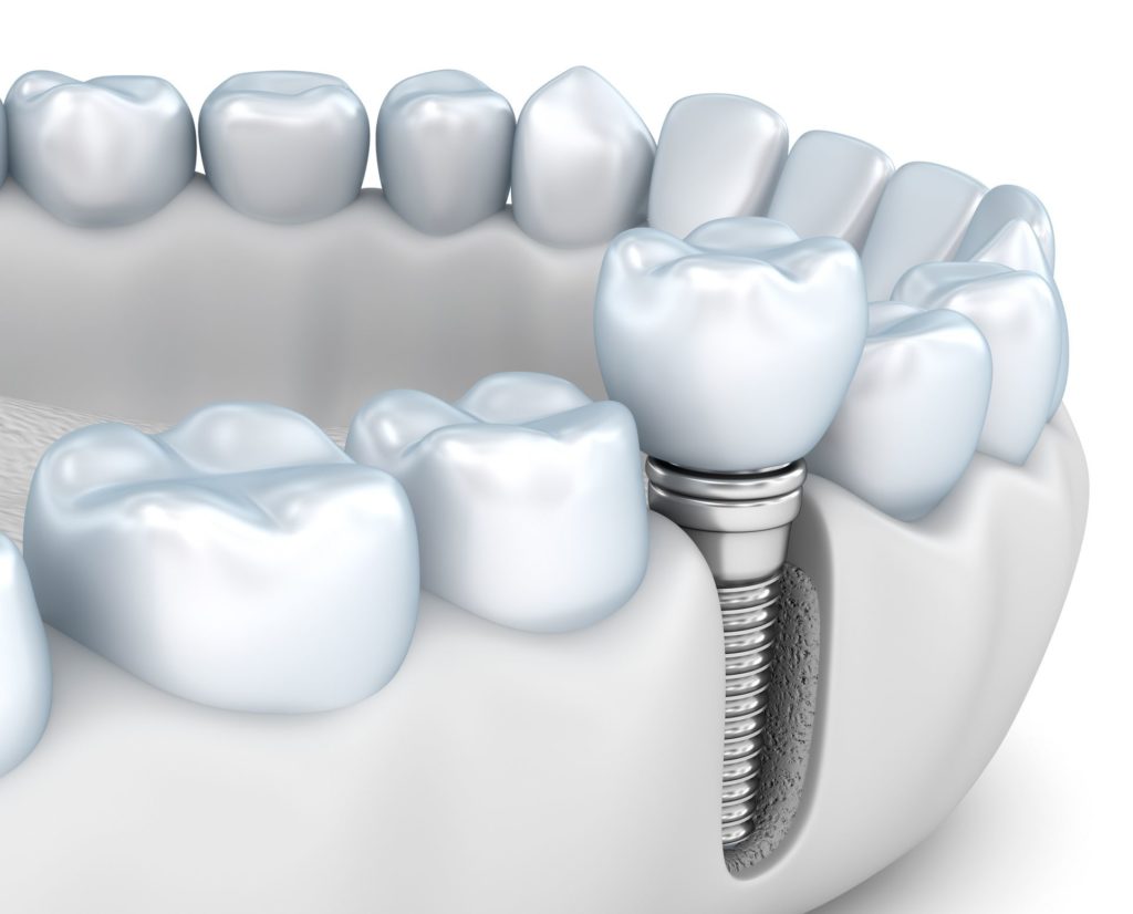 dental implants preserve jawbone in Columbia Maryland